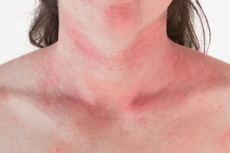 Book a Poikiloderma removal appointment at Crystal Palace Clinic