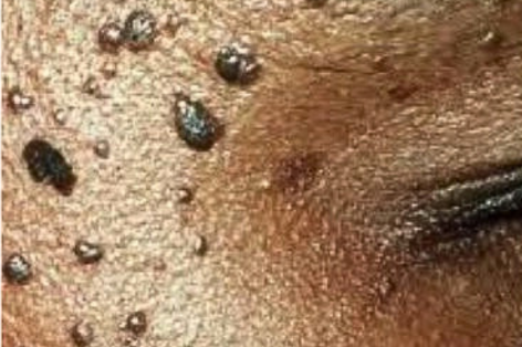 Dermatosis Papulosa Nigra removal at Crystal Palace Clinic